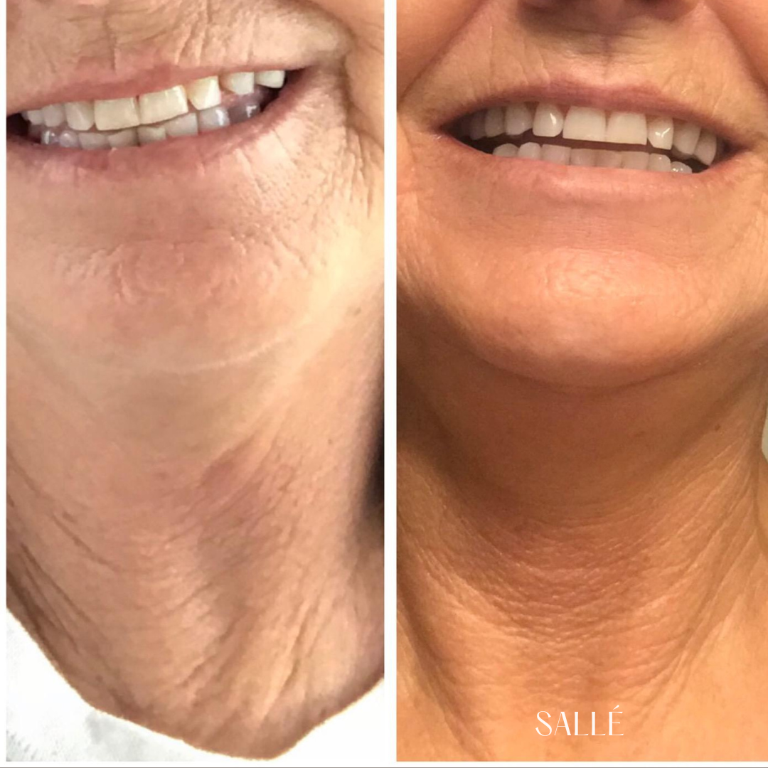 SALLÉ Crepey Skin Repair Treatment